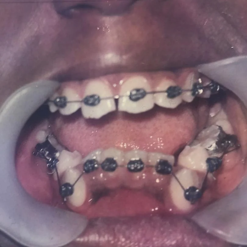 braces treatment in lekki