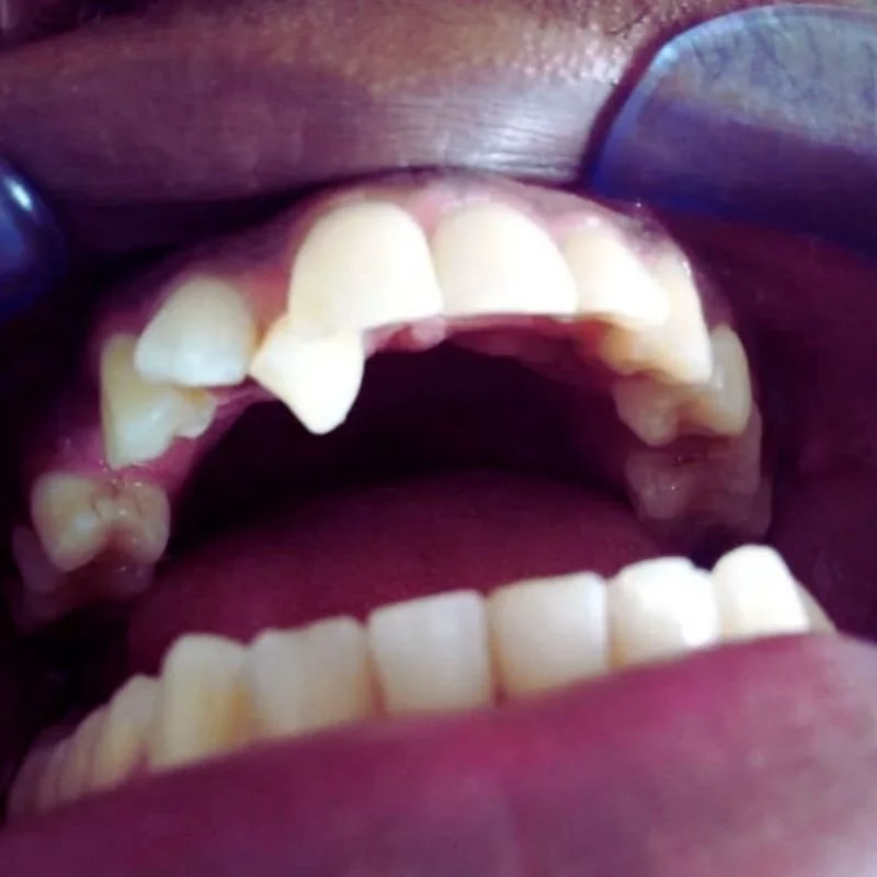 dental implant in lekki