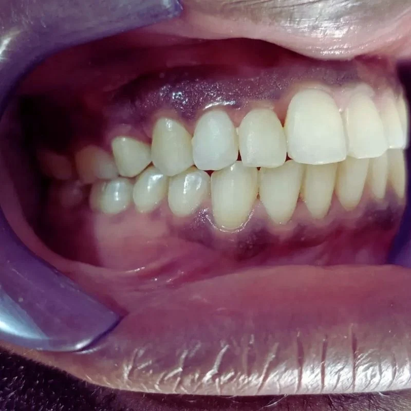 dental implant in vi