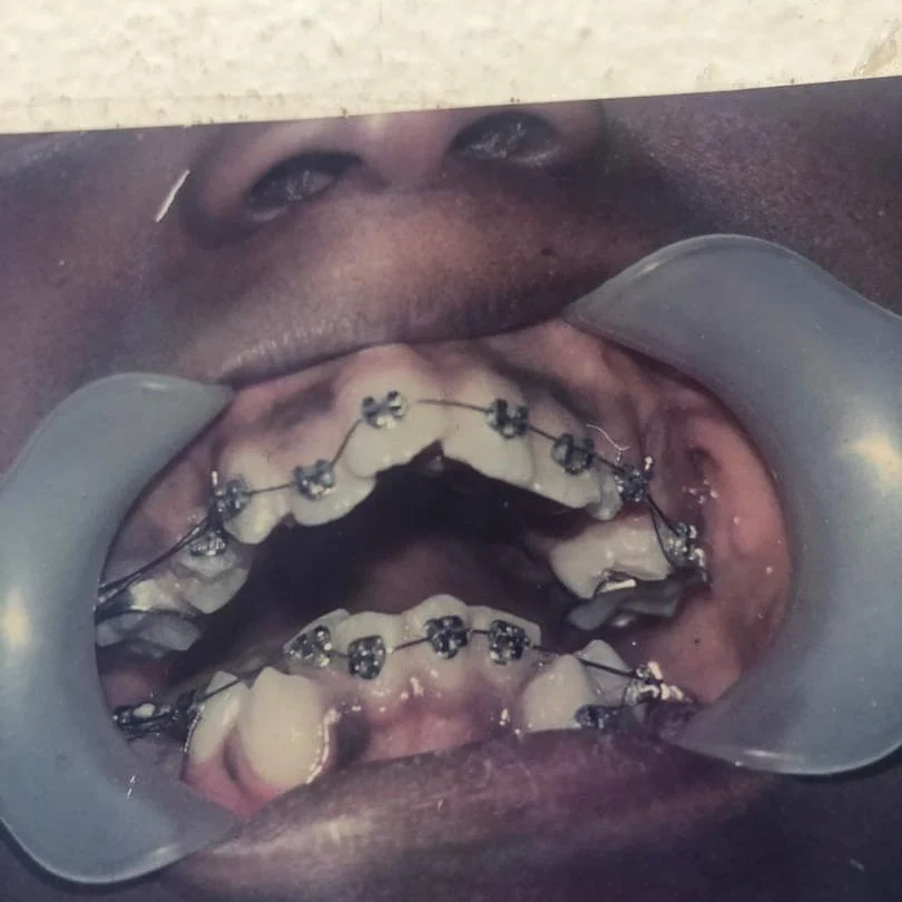 traditional ceramic braces for adults in lekki and ikoyi